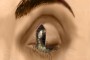 Floppy eyelid syndrome surgery repair Wedge